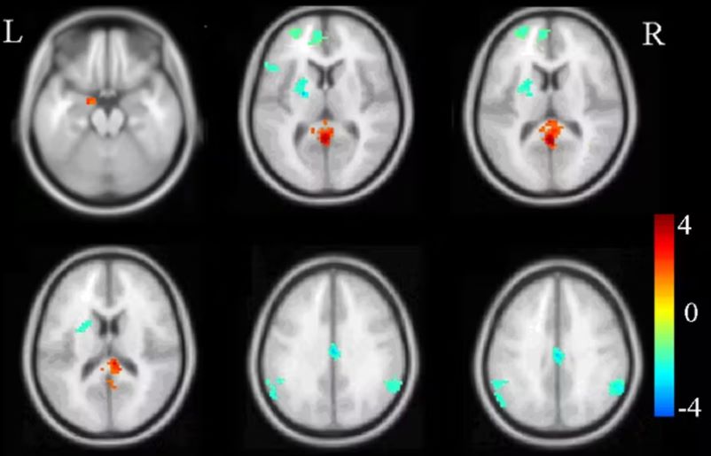Brain Scans Shed Light on PTSD but Cannot Diagnose It